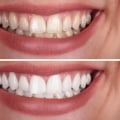 Unlocking the Secret: The Teeth Whitening Best Method Revealed!