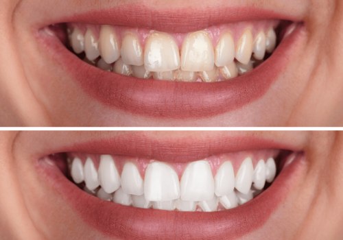 Unlocking the Secret: The Teeth Whitening Best Method Revealed!